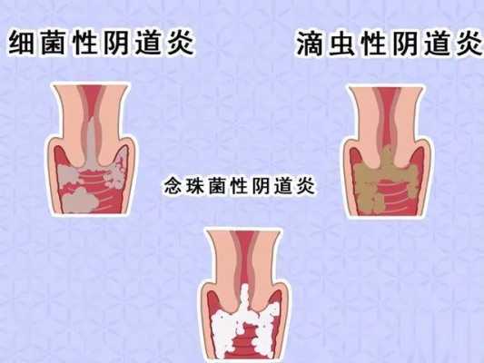 怀孕一个月左右有阴道炎会影响胎儿吗, 第2张 怀孕一个月左右有阴道炎会影响胎儿吗, 第2张
