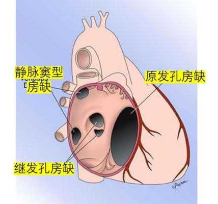 胎儿室间隔缺损2mm严重吗(新生儿房间隔缺损2mm能自愈吗) 第1张 胎儿室间隔缺损2mm严重吗(新生儿房间隔缺损2mm能自愈吗) 第1张