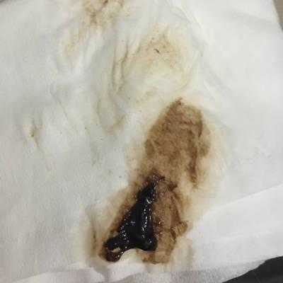 孕期出血宫腔有激液怎么办,孕期出血了 第3张 孕期出血宫腔有激液怎么办,孕期出血了 第3张