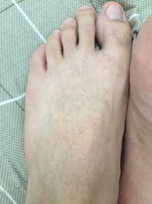 孕期脚面痒的难受怎么办,孕期脚面疼是怎么回事 第1张 孕期脚面痒的难受怎么办,孕期脚面疼是怎么回事 第1张
