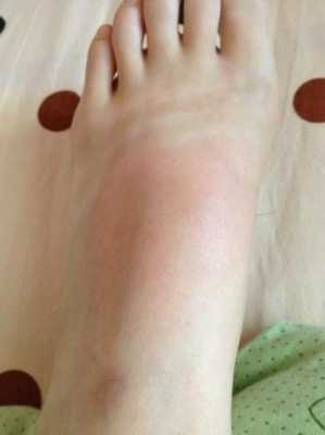 孕期脚面痒的难受怎么办,孕期脚面疼是怎么回事 第2张 孕期脚面痒的难受怎么办,孕期脚面疼是怎么回事 第2张