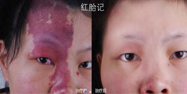 婴儿胎记怎么去除,怀孕胎儿胎记怎么引起的  第2张