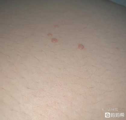 孕期寻常疣(孕期寻常疣) 第1张 孕期寻常疣(孕期寻常疣) 第1张