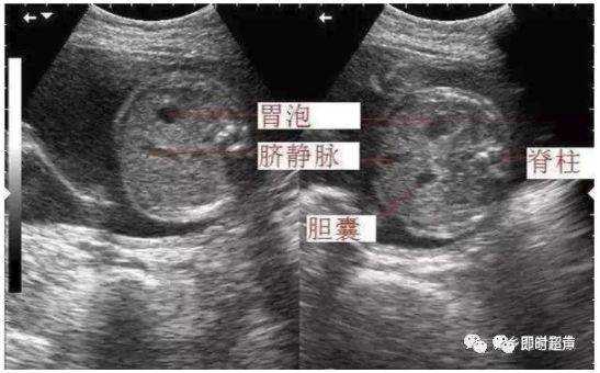 胎儿腹部超声(胎儿腹部超声切面图解) 第1张 胎儿腹部超声(胎儿腹部超声切面图解) 第1张