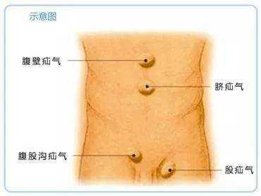 胎儿腹腔积水(腹腔积水该怎么治疗) 第3张 胎儿腹腔积水(腹腔积水该怎么治疗) 第3张
