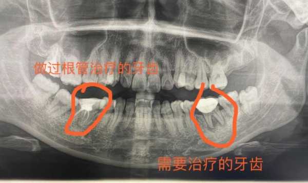 孕期拍牙片（孕期拍牙片,生下来小孩正常,对以后会不会有影响）  第2张