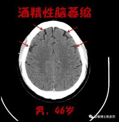 胎儿脑萎缩(胎儿脑萎缩能查出来吗) 第2张 胎儿脑萎缩(胎儿脑萎缩能查出来吗) 第2张