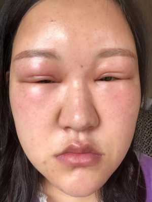 孕妇脸肿是什么原因,孕期脸水肿的原因造成的 第3张 孕妇脸肿是什么原因,孕期脸水肿的原因造成的 第3张