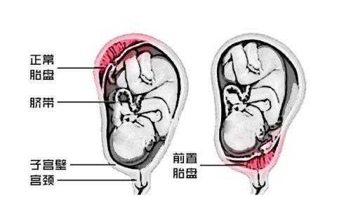胎儿位于前壁(胎儿位于前壁和后壁有什么区别) 第1张 胎儿位于前壁(胎儿位于前壁和后壁有什么区别) 第1张