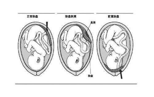 胎儿位于前壁(胎儿位于前壁和后壁有什么区别) 第2张 胎儿位于前壁(胎儿位于前壁和后壁有什么区别) 第2张