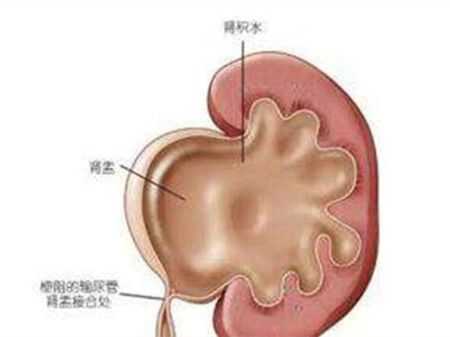 胎儿积水原因(胎儿积水原因有哪些) 第2张 胎儿积水原因(胎儿积水原因有哪些) 第2张