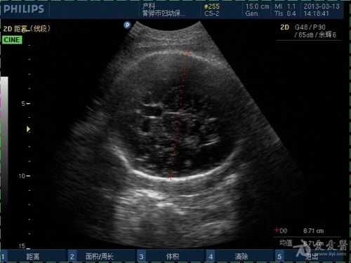 胎儿脑有囊肿(胎儿双侧侧脑室前角旁囊性囊肿怎么办) 第1张 胎儿脑有囊肿(胎儿双侧侧脑室前角旁囊性囊肿怎么办) 第1张