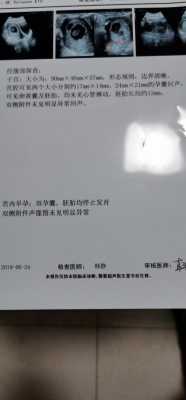 8周胎儿发育情况(怀孕了,过了8周还容易胎停吗?求告知) 第2张 8周胎儿发育情况(怀孕了,过了8周还容易胎停吗?求告知) 第2张