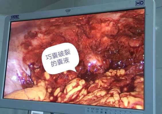 卵巢囊肿破裂怎么回事呢,孕期囊肿破裂什么症状 第1张 卵巢囊肿破裂怎么回事呢,孕期囊肿破裂什么症状 第1张