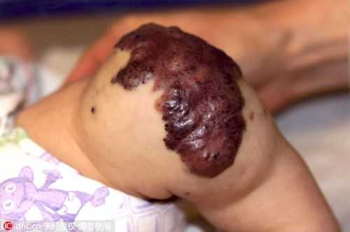 先天性血管畸形能彻底治好吗,胎儿畸形的10大征兆  第1张