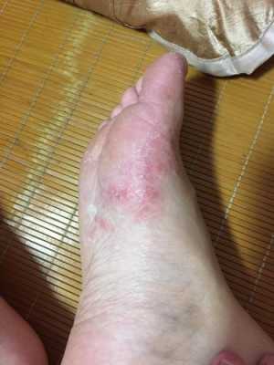 孕期犯脚气(孕期犯脚气痒怎么办) 第1张 孕期犯脚气(孕期犯脚气痒怎么办) 第1张