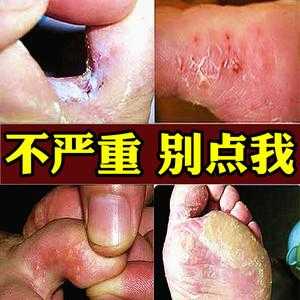 孕期犯脚气(孕期犯脚气痒怎么办) 第3张 孕期犯脚气(孕期犯脚气痒怎么办) 第3张
