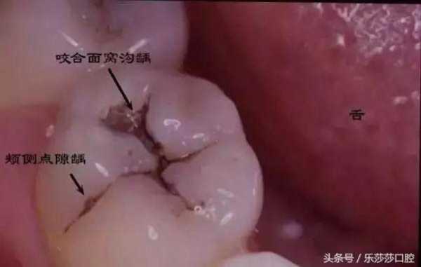 孕期牙破了(孕期牙破了个洞神经疼怎么办) 第1张 孕期牙破了(孕期牙破了个洞神经疼怎么办) 第1张
