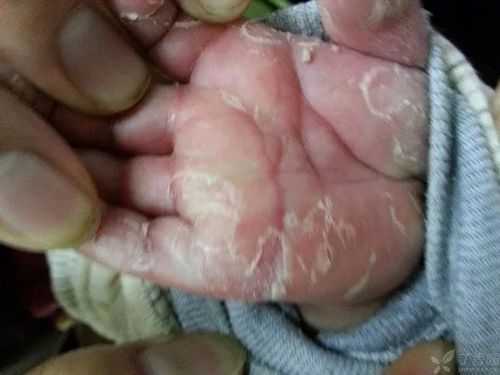 梅毒孕妇生下的孩子会怎样,孕期角膜炎对胎儿有影响吗 第3张 梅毒孕妇生下的孩子会怎样,孕期角膜炎对胎儿有影响吗 第3张