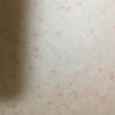 孕期肚皮长红点(孕期肚皮长红点可以擦茶油吗) 第1张 孕期肚皮长红点(孕期肚皮长红点可以擦茶油吗) 第1张