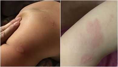 有荨麻疹能不能怀孕生小孩,荨麻疹对胎儿影响大吗 第1张 有荨麻疹能不能怀孕生小孩,荨麻疹对胎儿影响大吗 第1张