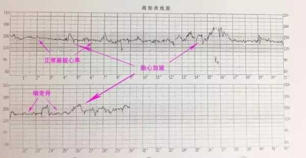 胎儿身体动(做胎心监护宝宝老动一动心率就快正常么) 第2张 胎儿身体动(做胎心监护宝宝老动一动心率就快正常么) 第2张