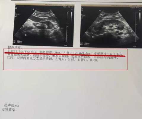 医生说可能胎儿右肾会偏小,应该怎么办,胎儿肾变小了是不是萎缩了 第3张 医生说可能胎儿右肾会偏小,应该怎么办,胎儿肾变小了是不是萎缩了 第3张