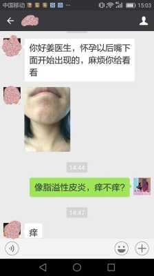 孕期皮炎的治疗方法(孕期皮炎的治疗方法有哪些) 第2张 孕期皮炎的治疗方法(孕期皮炎的治疗方法有哪些) 第2张