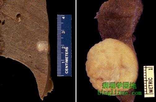 胎儿错构瘤(胎儿错构瘤严重吗) 第2张 胎儿错构瘤(胎儿错构瘤严重吗) 第2张