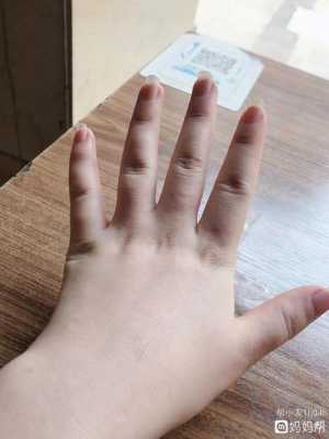 怀孕期手肿(孕31周,手肿怎么办) 第2张 怀孕期手肿(孕31周,手肿怎么办) 第2张