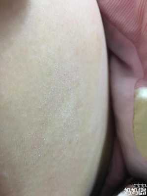 孕期肚皮干燥起皮图片(孕期肚皮干燥起皮图片大全) 第1张 孕期肚皮干燥起皮图片(孕期肚皮干燥起皮图片大全) 第1张