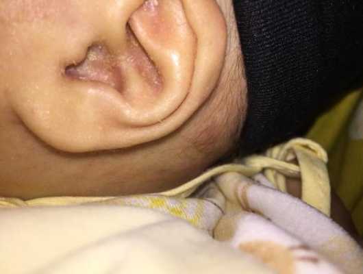 耳朵里面湿疹流水怎么办,孕期湿疹流水怎么办啊 第1张 耳朵里面湿疹流水怎么办,孕期湿疹流水怎么办啊 第1张