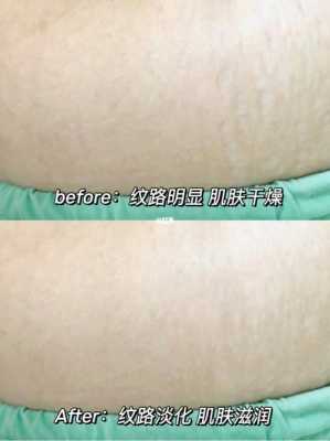 孕期妊娠纹消除方法(孕期妊娠纹消除方法有哪些) 第3张 孕期妊娠纹消除方法(孕期妊娠纹消除方法有哪些) 第3张