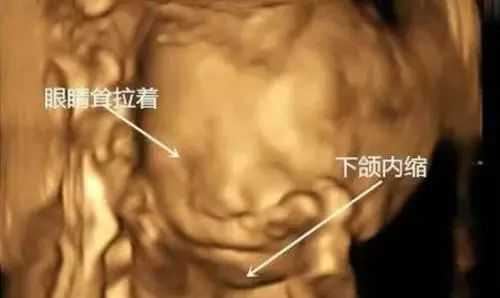 胎儿小下颌畸形图片(下颌后缩是怎么回事) 第1张 胎儿小下颌畸形图片(下颌后缩是怎么回事) 第1张