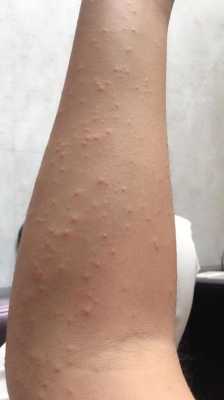孕妇湿疹很严重怎么办呢,孕期全身湿疹怎么办啊 第2张 孕妇湿疹很严重怎么办呢,孕期全身湿疹怎么办啊 第2张