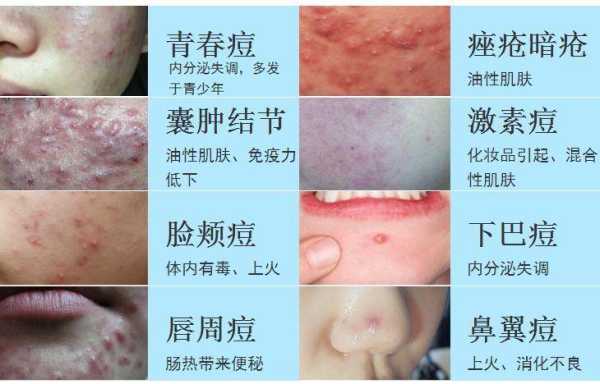 孕期痤疮怎么治疗方法(孕期痤疮怎么治疗方法) 第2张 孕期痤疮怎么治疗方法(孕期痤疮怎么治疗方法) 第2张