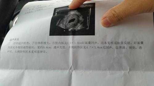 胎儿没胎心原因(胎儿突然没有胎心原因是什么啊?是胎停了吗) 第2张 胎儿没胎心原因(胎儿突然没有胎心原因是什么啊?是胎停了吗) 第2张