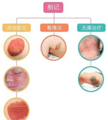 新生儿为什么有胎记,怎样预防胎儿长胎记的发生 第3张 新生儿为什么有胎记,怎样预防胎儿长胎记的发生 第3张