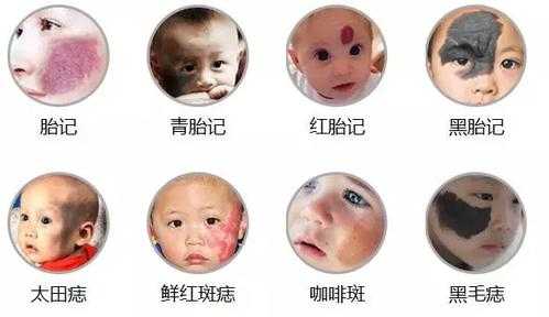 新生儿为什么有胎记,怎样预防胎儿长胎记的发生 第1张 新生儿为什么有胎记,怎样预防胎儿长胎记的发生 第1张