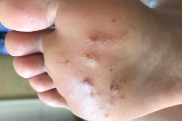 孕期脚长湿疹怎么办(脚底长湿疹怎么治疗) 第1张 孕期脚长湿疹怎么办(脚底长湿疹怎么治疗) 第1张