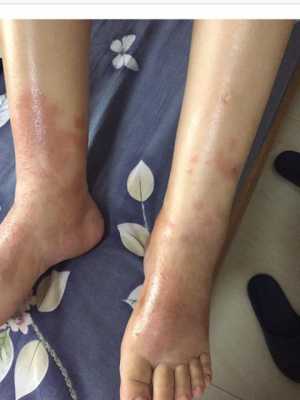 孕期皮肤病怎么治疗(孕期皮肤病怎么治疗最好) 第2张 孕期皮肤病怎么治疗(孕期皮肤病怎么治疗最好) 第2张