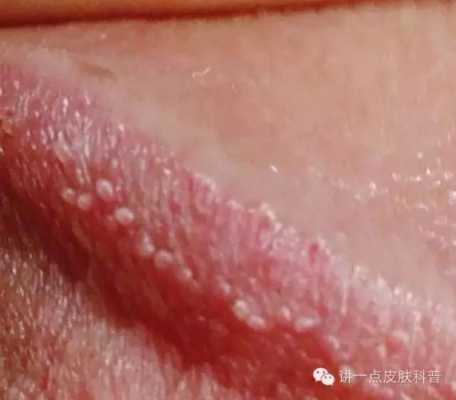 尖锐湿疣影响胎儿吗（得了尖锐湿疣，还能顺产吗）  第2张