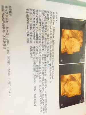 胎儿腿短结果是畸形(胎儿腿短结果是畸形怎么办) 第2张 胎儿腿短结果是畸形(胎儿腿短结果是畸形怎么办) 第2张