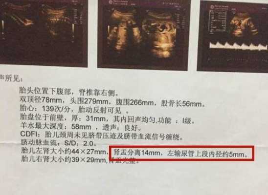 胎儿双肾盂分离知男女(胎儿双肾盂分离男女比例) 第1张 胎儿双肾盂分离知男女(胎儿双肾盂分离男女比例) 第1张