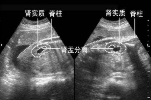 胎儿双肾盂分离知男女(胎儿双肾盂分离男女比例) 第2张 胎儿双肾盂分离知男女(胎儿双肾盂分离男女比例) 第2张