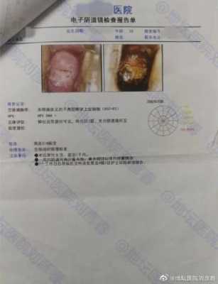 孕期鳞状上皮细胞偏高(鳞状上皮细胞内高度病变是什么疾病,有什么症状) 第2张 孕期鳞状上皮细胞偏高(鳞状上皮细胞内高度病变是什么疾病,有什么症状) 第2张