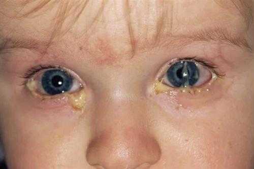 孕妇结膜炎影响胎儿吗(孕妇结膜炎影响胎儿吗视频) 第2张 孕妇结膜炎影响胎儿吗(孕妇结膜炎影响胎儿吗视频) 第2张