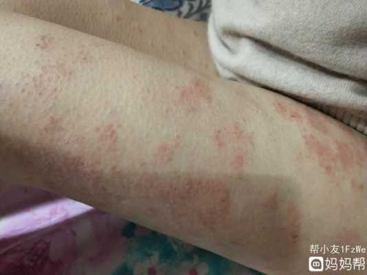 怀孕了长湿疹怎么办,怀孕期间为什么长湿疹呢 第2张 怀孕了长湿疹怎么办,怀孕期间为什么长湿疹呢 第2张