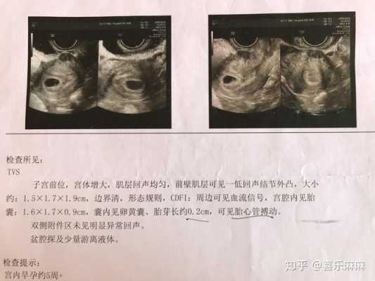 胎儿多久长胎心胎芽(怀孕多久有胎芽) 第3张 胎儿多久长胎心胎芽(怀孕多久有胎芽) 第3张