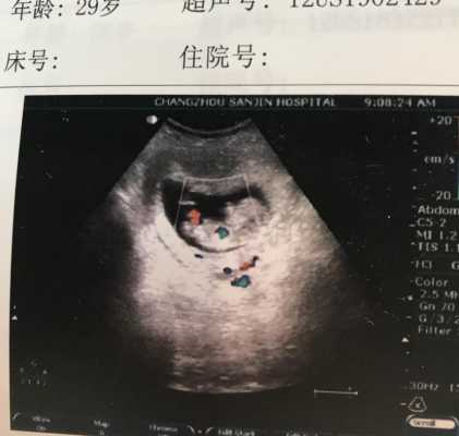 胎儿签定(胎儿签定男孩女孩要多久才有结果单) 第3张 胎儿签定(胎儿签定男孩女孩要多久才有结果单) 第3张